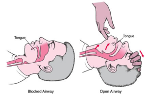 Airway