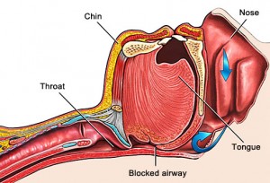 Blocked airway