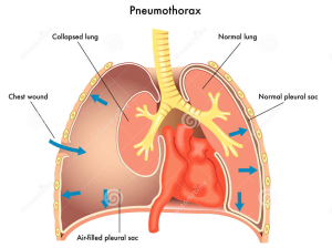 Pneumothorax