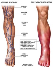 First aid for DVT