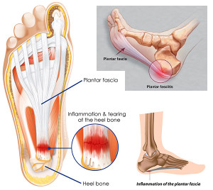 First aid for Plantar Fasciitis