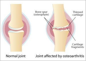 First aid for osteoarthritis