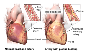 Angina first aid