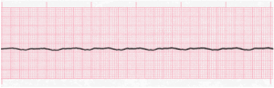 Asystole