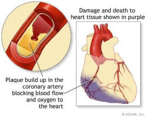 How to recognise a heart attack