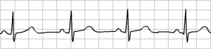 Sinus Rhythm