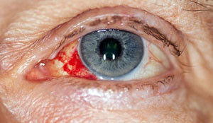 Subconjunctival hemorrhage