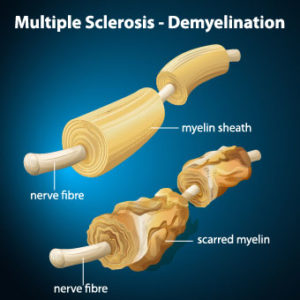 multiple-sclerosis