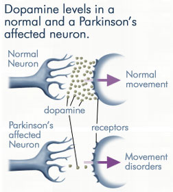 dopamine-parkinsons-disease